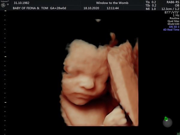 Catching up - TTC After Miscarriage part 3