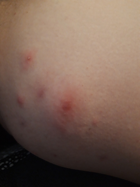 What is this boil/spot ....