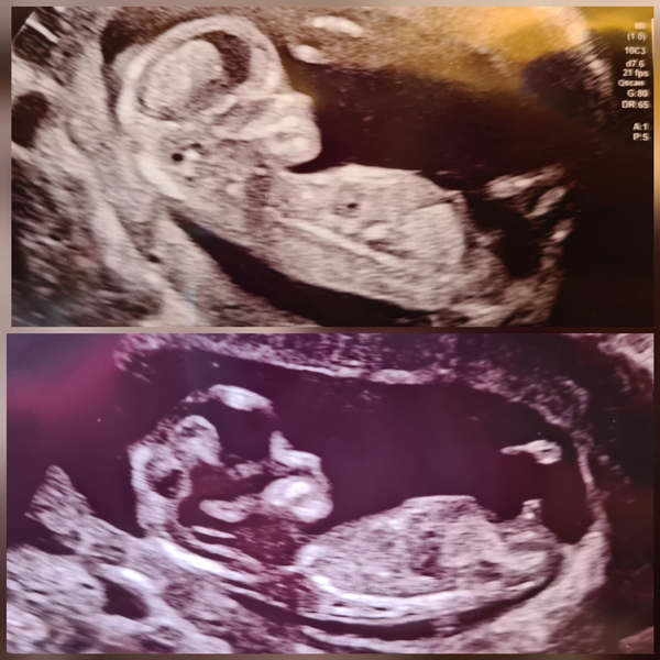 Boy or Girl?