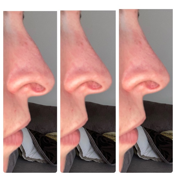 Has anyone here had rhinoplasty and do you regret it?