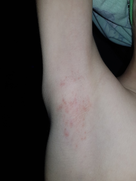 AIBU to ask what this rash is?