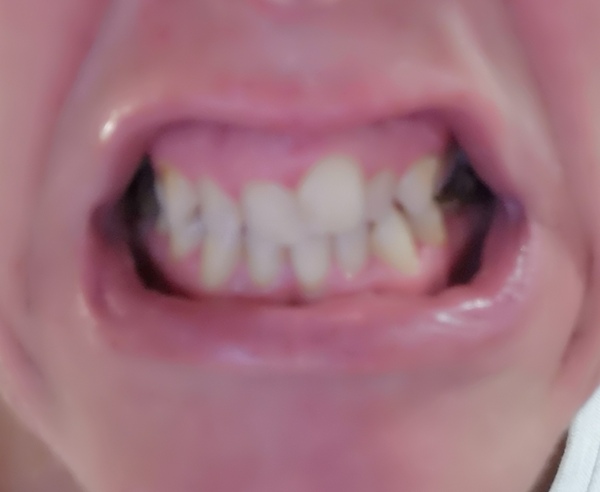 To ask if you've had Invisalign braces?