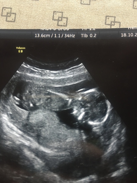 Private gender scan tomorrow