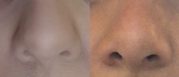 Has anyone here had rhinoplasty and do you regret it?