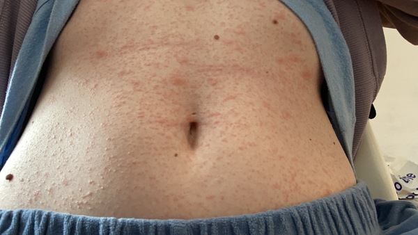 Has anyone with coronavirus had a rash as a symptom?