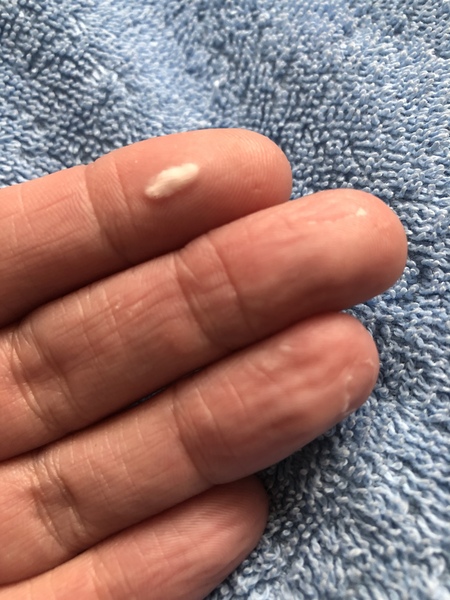 Peeling skin on finger tips, alcohol gel related? Photo included.