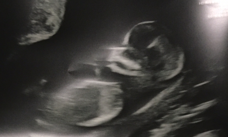 Pregnant After MMC - Thread 3