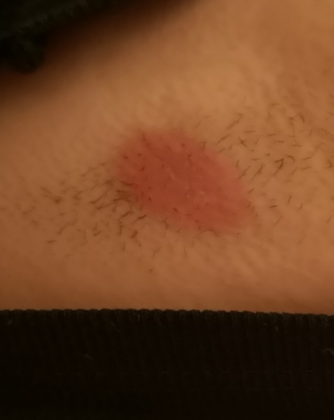 AIBU to ask what this rash is?