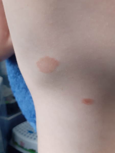 Rash????