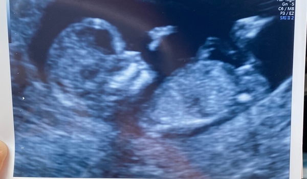 Boy or girl? Any nub theory guesses?