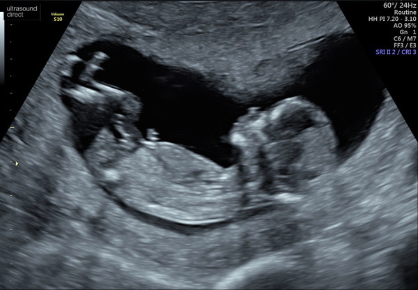 Boy or girl