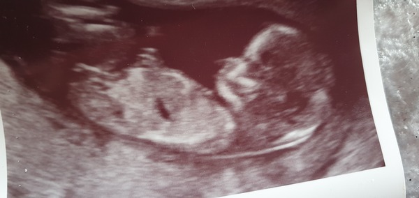 Sex of baby!!!! 12 week scan