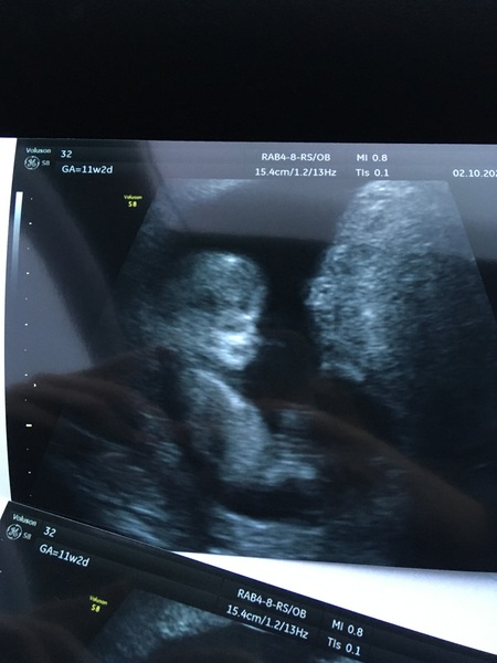 Pregnant After MMC - Thread 3