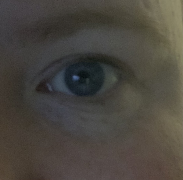 I've made an appointment for tear trough fillers
