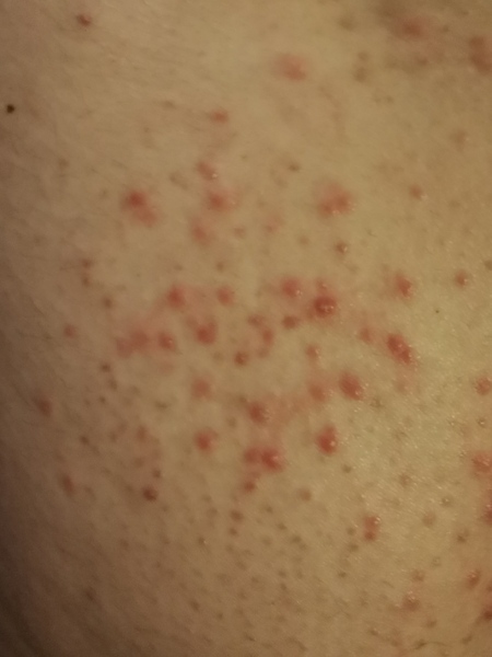 Rash or acne (photo)