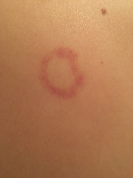 What is this rash ?