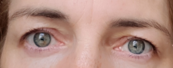 Should I get eyelids fixed?