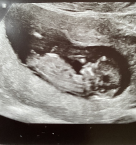 Boy or Girl