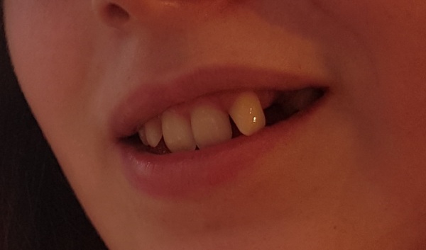 Eye tooth