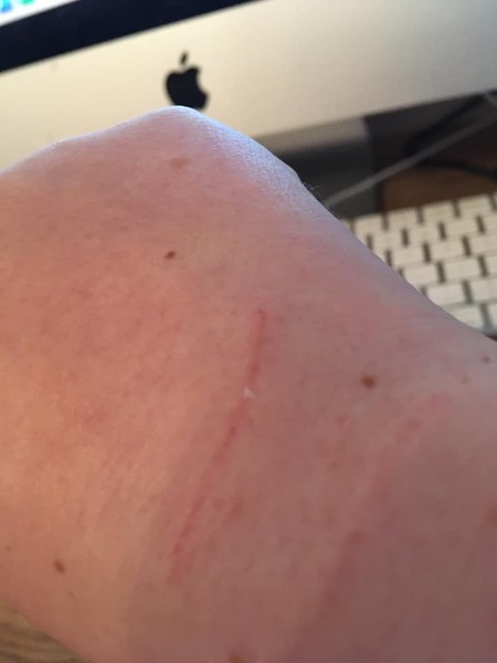 Dealing with a cat bite