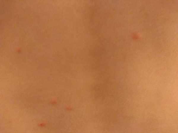 What could these spots/rash be?