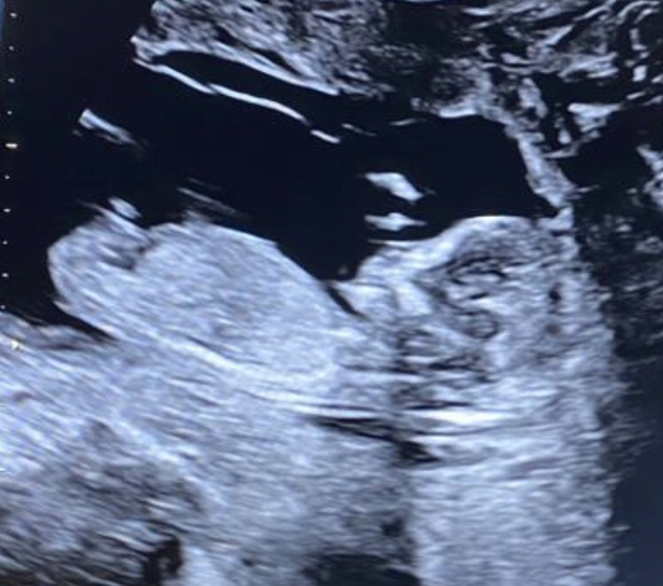 Boy or Girl?