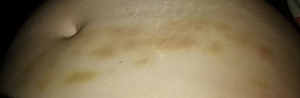 Unexplained bruising