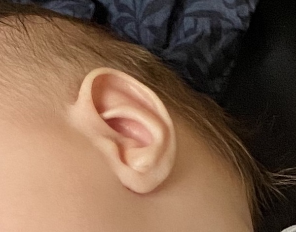 Deformed ear in 3 month old