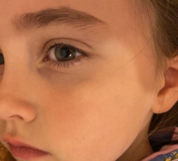 Lump on DD’s face. Really worried!! *pic attached