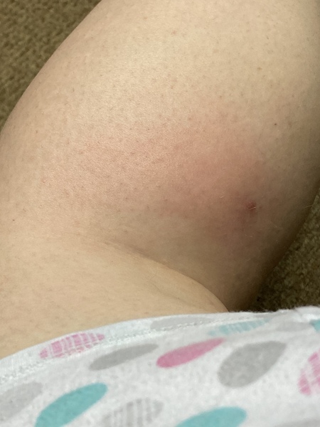 Does this need a GP? Abcess (Photo warning)