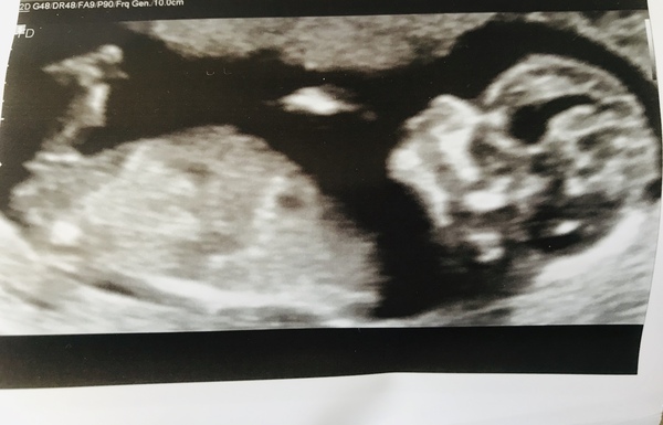 Anyone agree looks like a boy?!