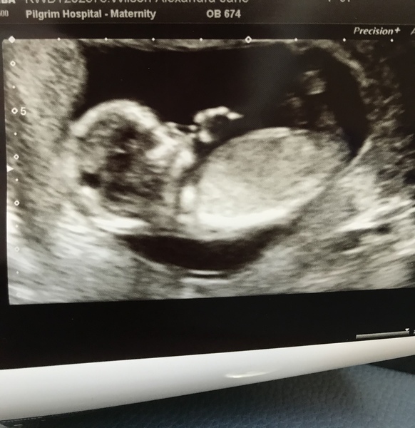 Catching up - TTC After Miscarriage part 3
