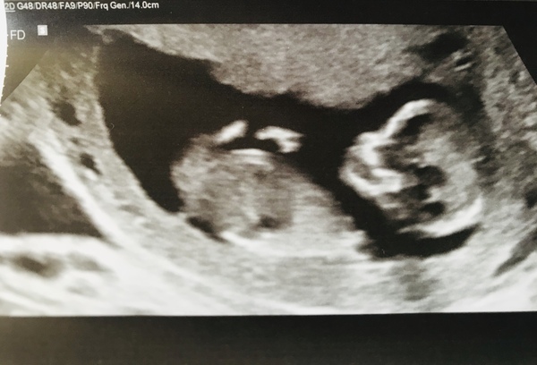 Anyone know what this is on my scan picture?