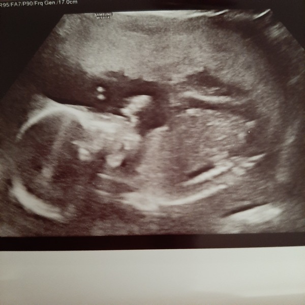 Catching up - TTC After Miscarriage part 3