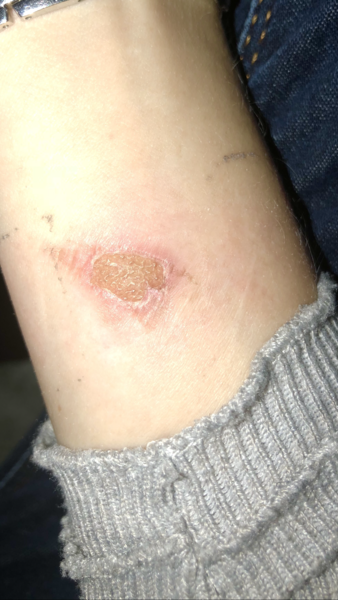Do I need to get this looked at - small burn. Photo