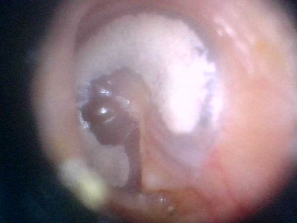 I bought a camera that looks inside my ears