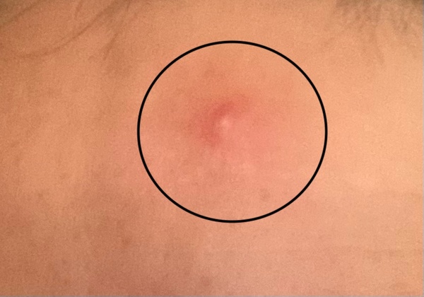 Blind spot, approx size of Australia, currently residing on forehead