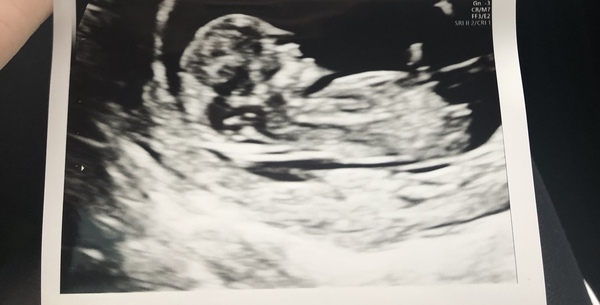 TTC after a chemical pregnancy / early miscarriage