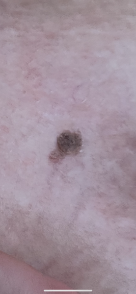Raised itchy mole