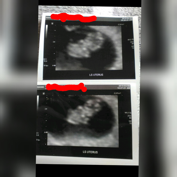 Does this scan look normal? 8 weeks