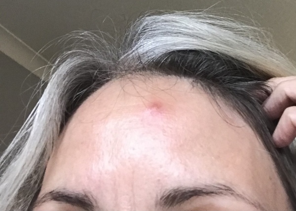 Blind spot, approx size of Australia, currently residing on forehead