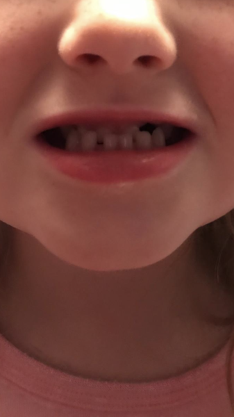 Is this overbite bad?