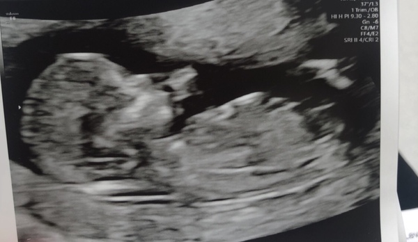 Boy or girl? Desperate to know now! :)