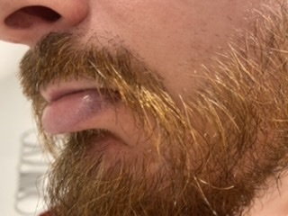 DH lips turning blue