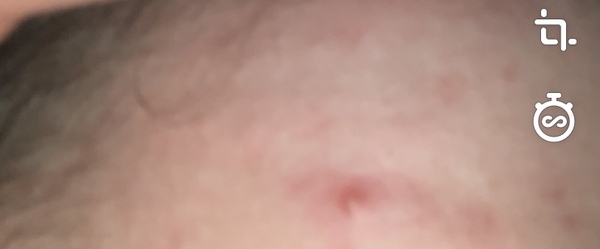 What type of pimple is this?