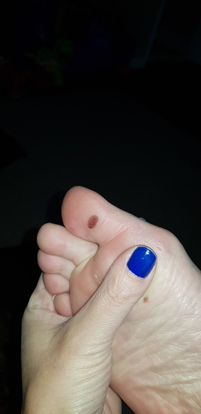 Melonoma ?