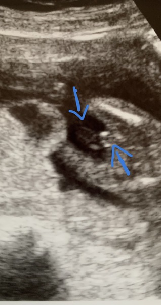 Gender reveal + potty shot