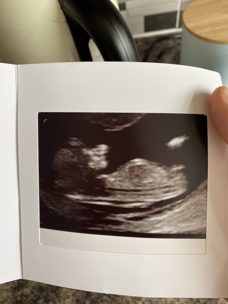 Nub theory? Boy or girl?
