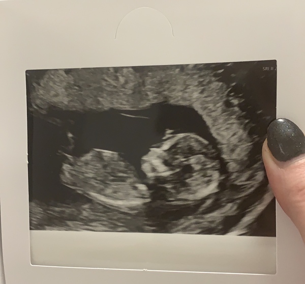 Pregnant After MMC - Thread 3