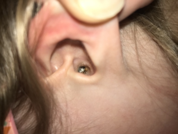 8 year old ear pain (wax pic)